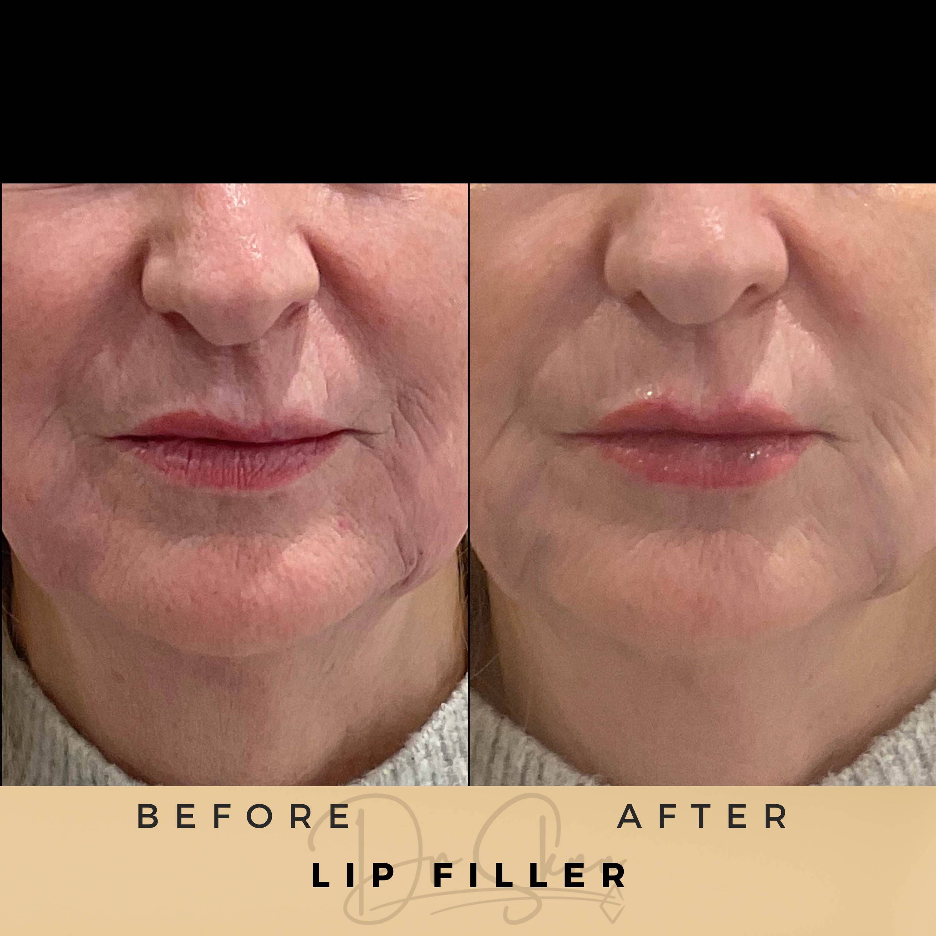 Lip Fillers - Dr Sknn before and after