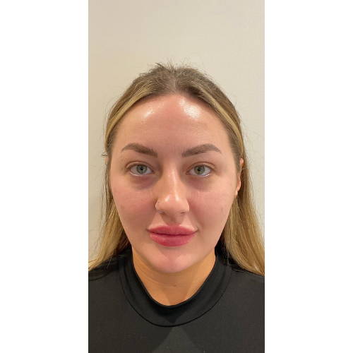 Dr Sknn Tear Cheek Dermal Fillers After
