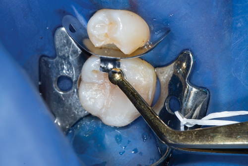 dental band being placed with tweezers