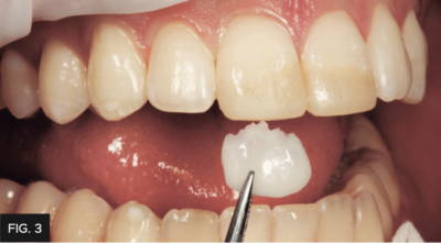 Custom composite mock-up approaching anterior tooth