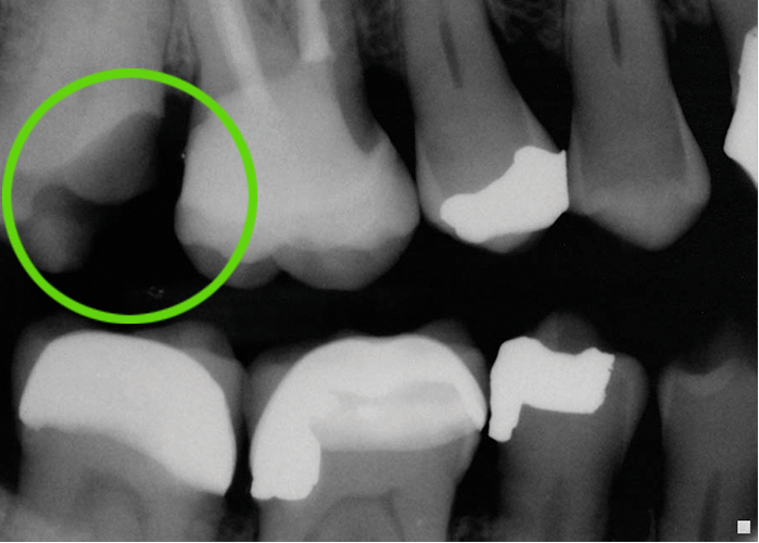 Teeth x-ray with green circle highligting missing piece of tooth