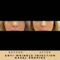 Nasal Tip Anti-Wrinkle Injections Wilmslow Before & After Dr Sknn