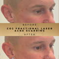 Acne Scar Treatment Co2 Fractional Laser Wilmslow Dr Sknn Before & After Picture