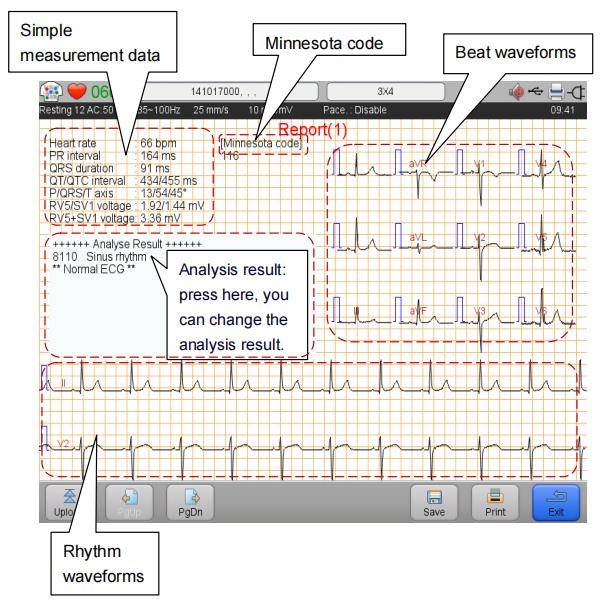 rapport ECG d'analyse simple