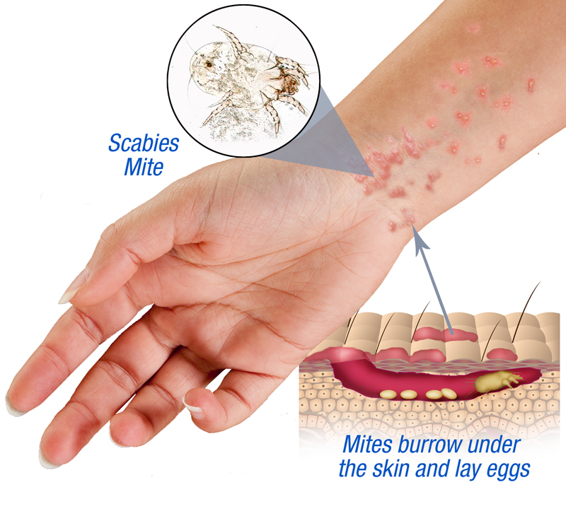 What is a scabies rash?