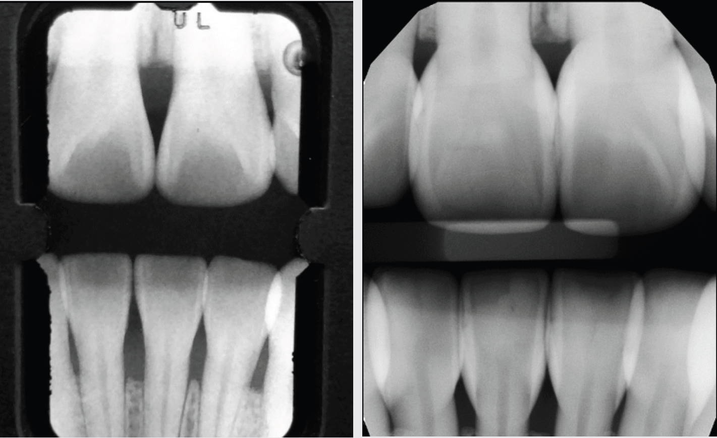 A radiograph pre-op and 6 years post-op