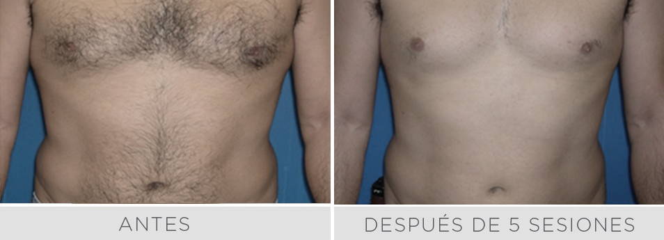 Antes y después de 5 sesiones de depilación láser en tórax y abdomen