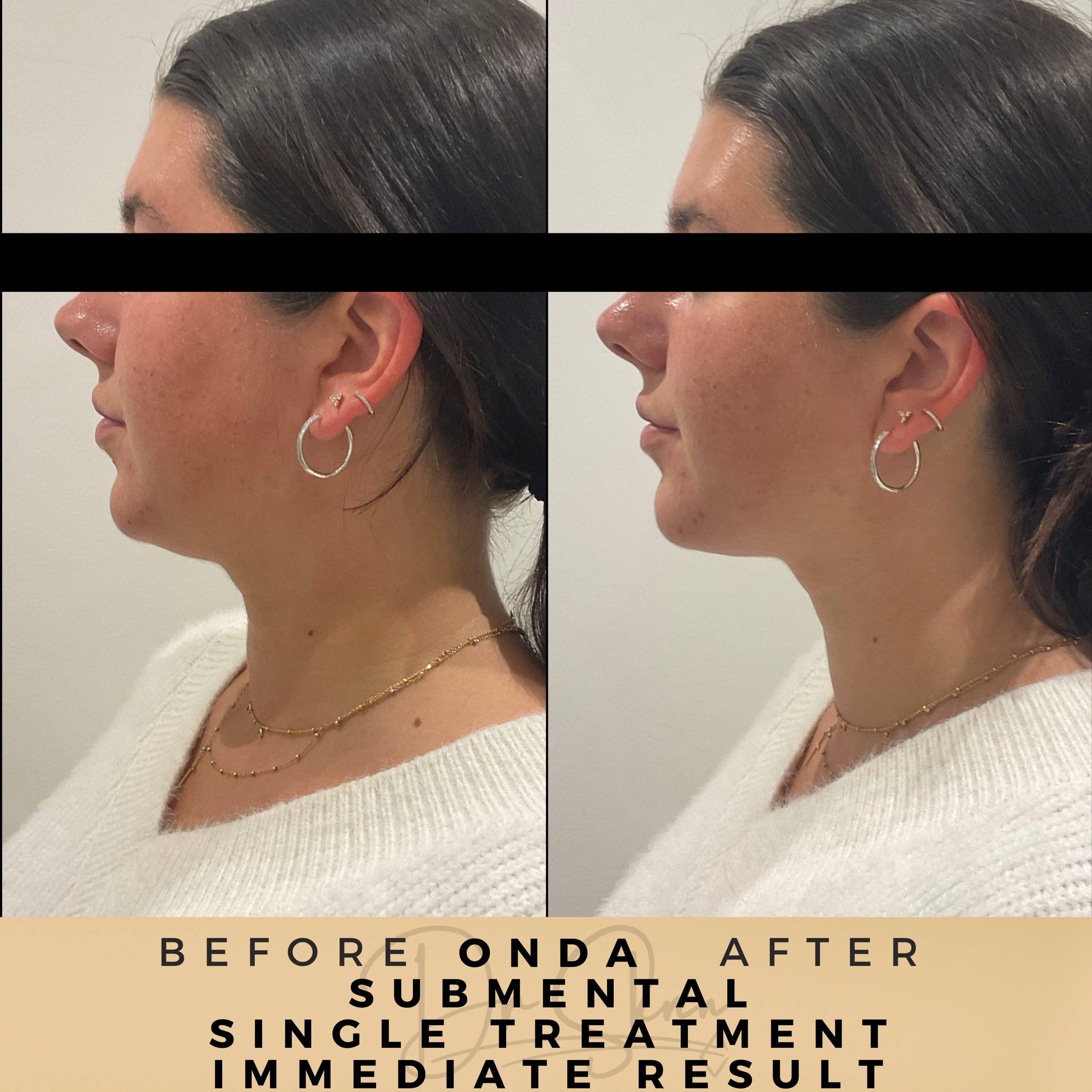 Fat Reduction - Non-surgical - Dr Sknn before and after