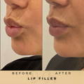 Lip Fillers Wilmslow with Anti-wrinkle injections