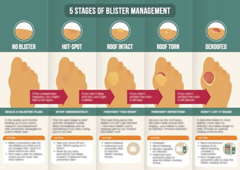 The 5 Stages of Blister Management