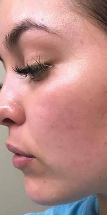 WunderHaut Anti-Aging Genius™ mit Radiofrequenz, LED Licht- und Mesotherapie, EMS und Elektroporation