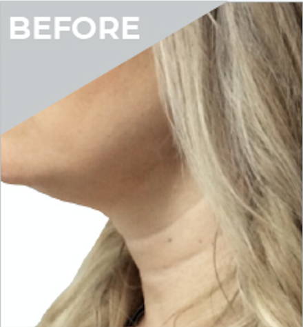 Dr Sknn Non-Surgical Face & Neck Lift Before