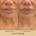 Lip Fillers Wilmslow with Anti-wrinkle injections
