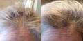 Nulastin-Scalp-Hair-Results-Before-After