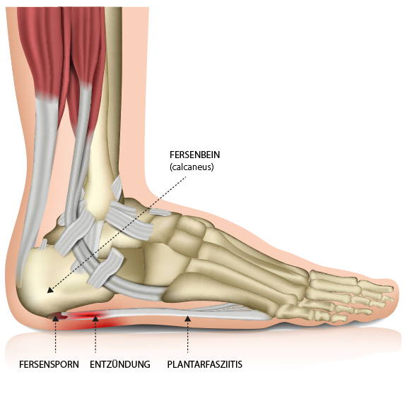 Abbildung Fersenbein, dem Fersensporn  und der Ertzündung Plantarfaszits