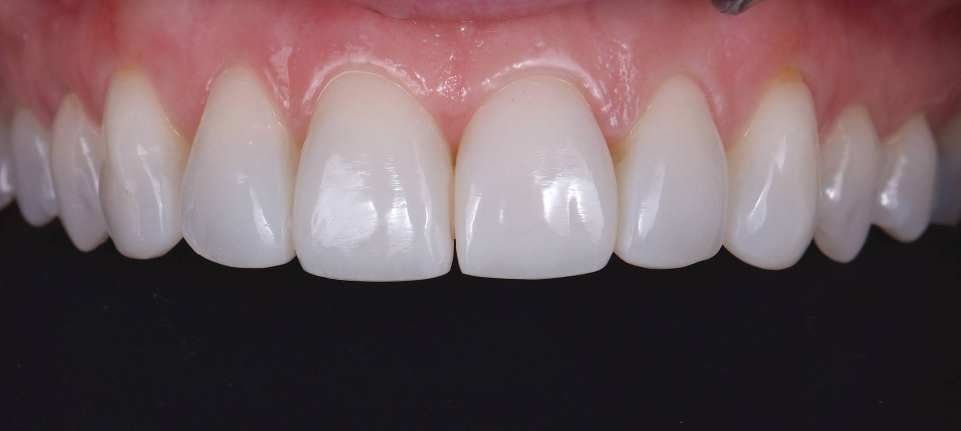 Upper teeth after procedure