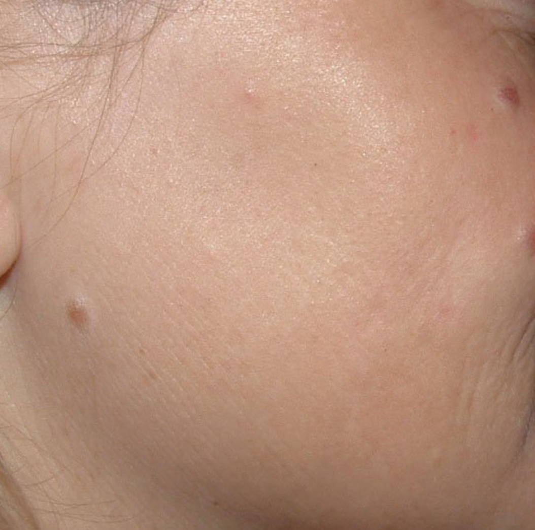 Intense Pulsed Light Pigmentation Removal After