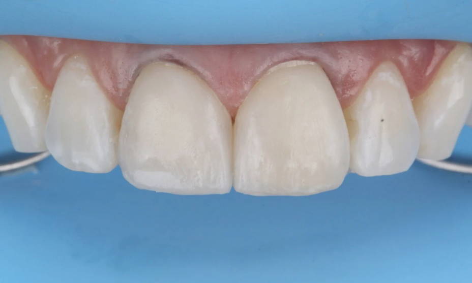 composite used to create tight contacts