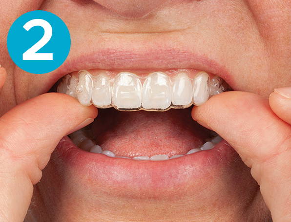 Adjusting aligner tray into upper teeth using both thumbs