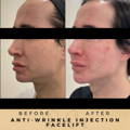 Liquid Facelift Wilmslow with Anti-wrinkle injections