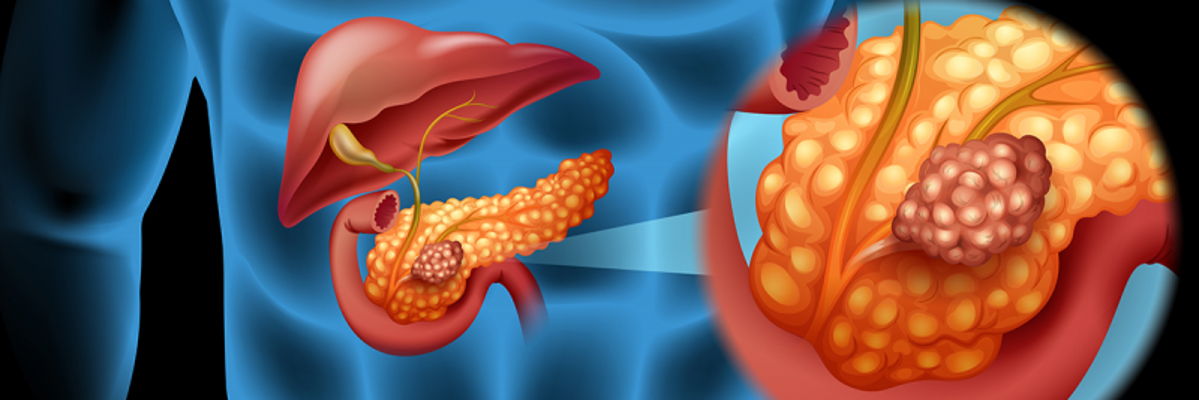 Pancreatic Cancer: 10 Symptoms and What to Eat to Reduce Them