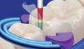 Clark's Class II: step 9