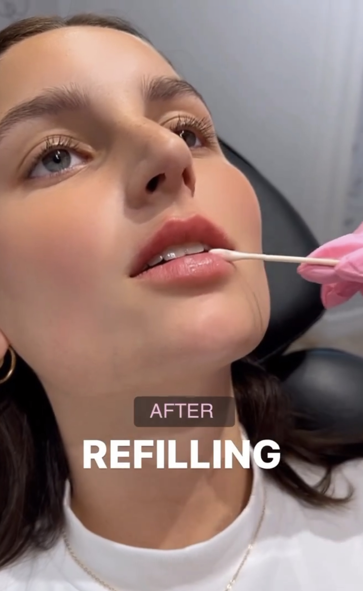 Lip Revision: Restoring Natural Shape transformation