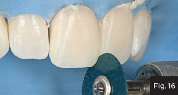  adjustment of the incisal embrasures using a Contours™ Finishing and Polishing Disc