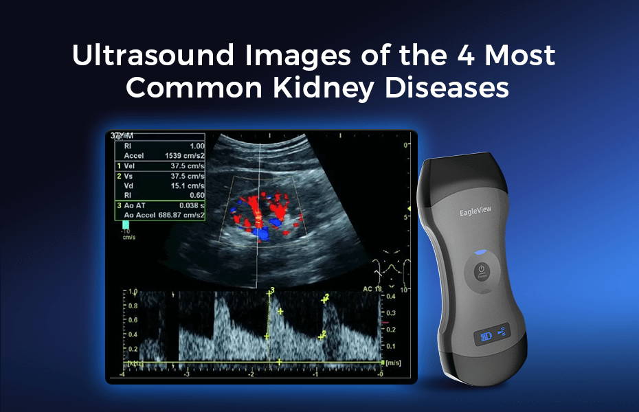 Kidney Ultrasound Images: 4 Common Conditions and Scan Tips Using EagleView Portable Ultrasound