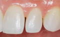 upper teeth showing gaps 