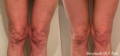 Woman's wrinkled knees before and after Morpheus8