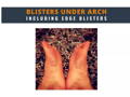 Blisters under arch