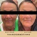 Before & After Pictures Dr Sknn Wilmslow Cheshire