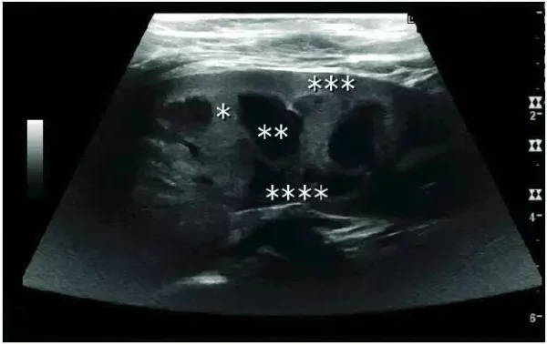 Normal child kidney ultrasound — EagleView portable ultrasound.