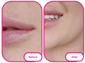 the area around the lips before and after taking the best collagen gummies from reviews 