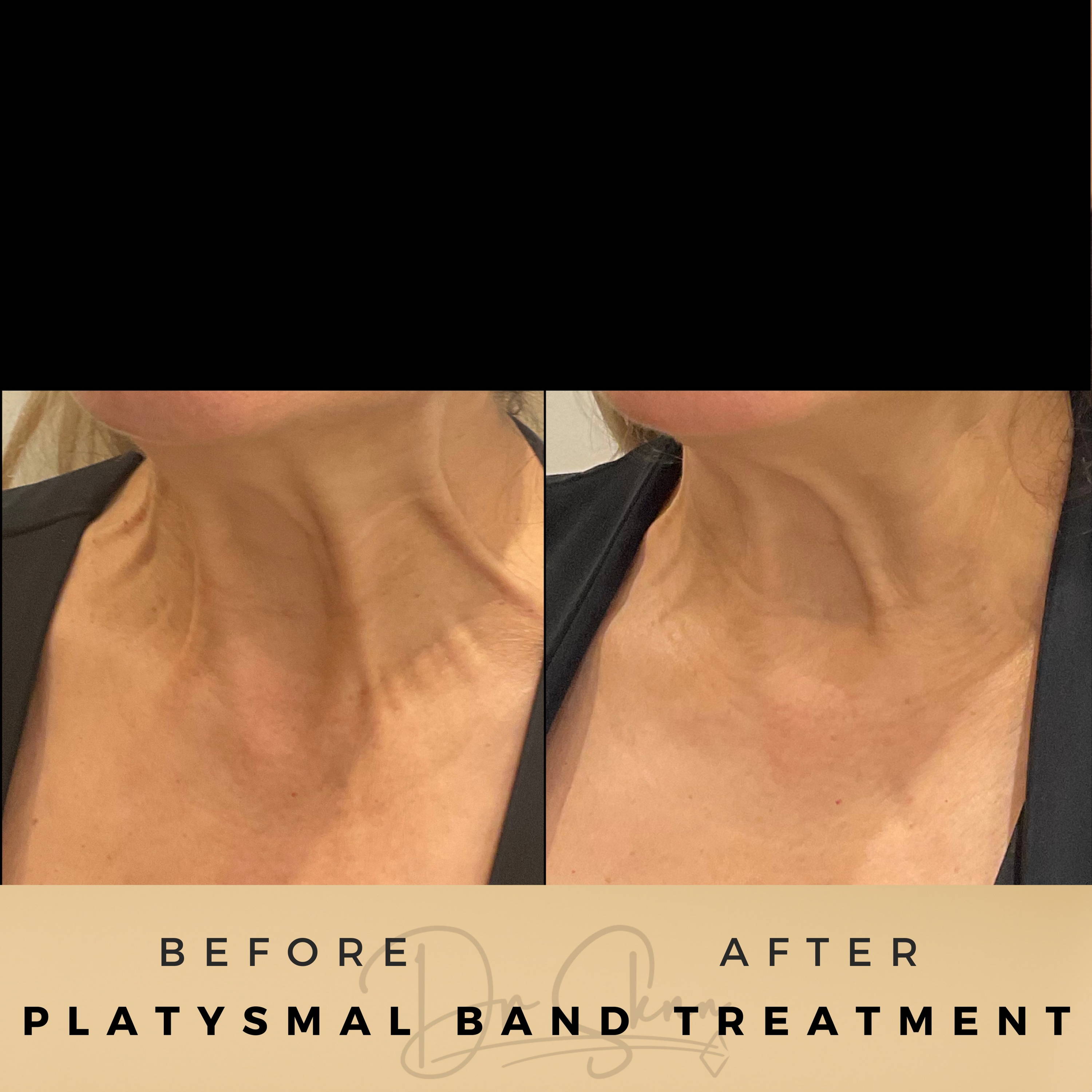 Platysmal Bands Wilmslow Before & After Dr Sknn