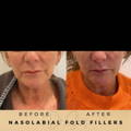 Nasolabial Fold Fillers Wilmslow