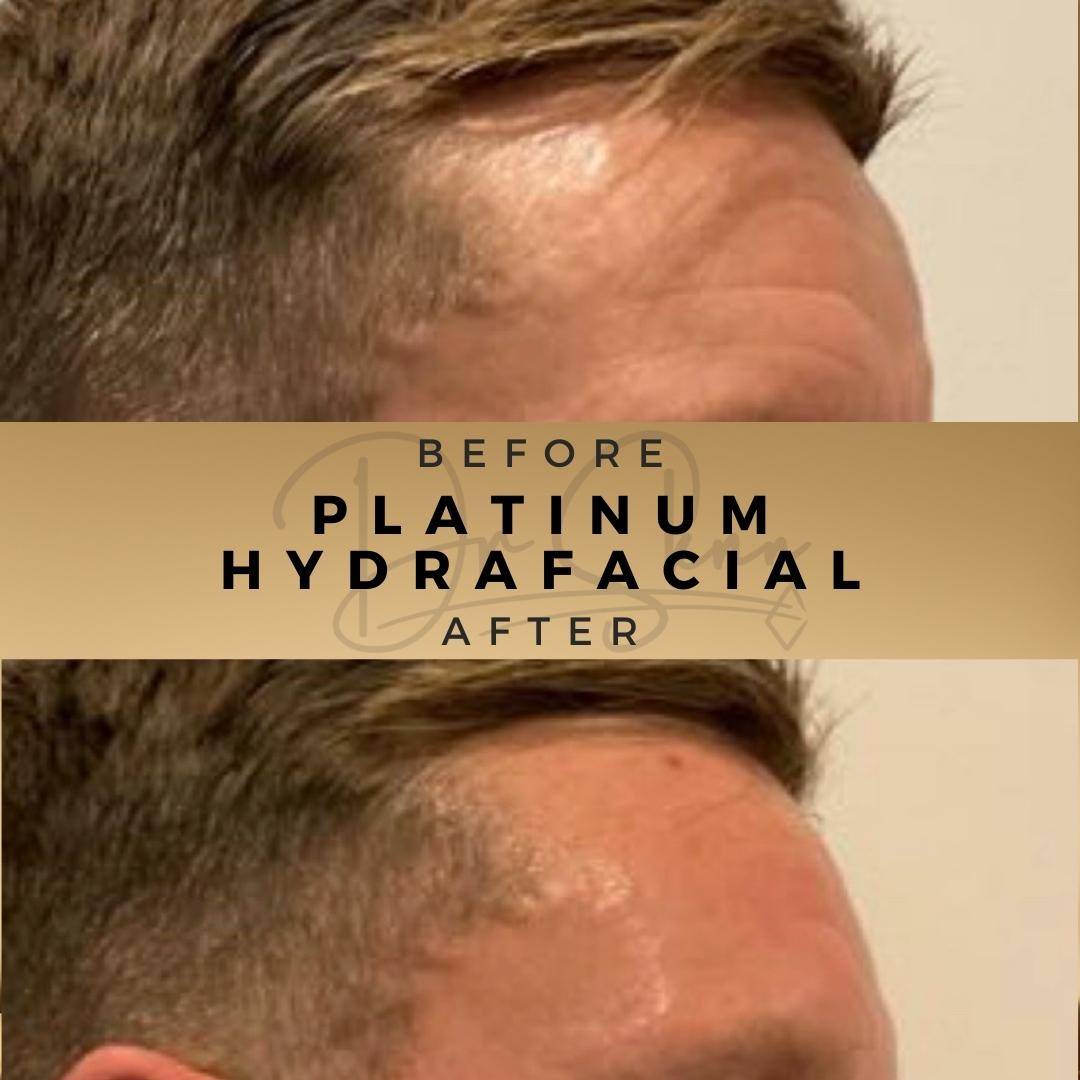 HydraFacial Wilmslow Before & After Dr Sknn