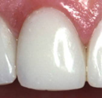 Renamel Microfill composite is then placed to recreate enamel surface followed by final polish.