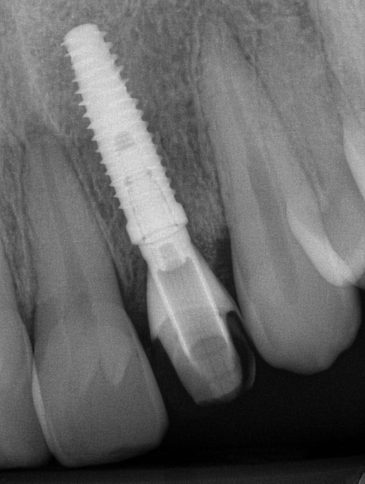 X-ray of temporary crown on implant