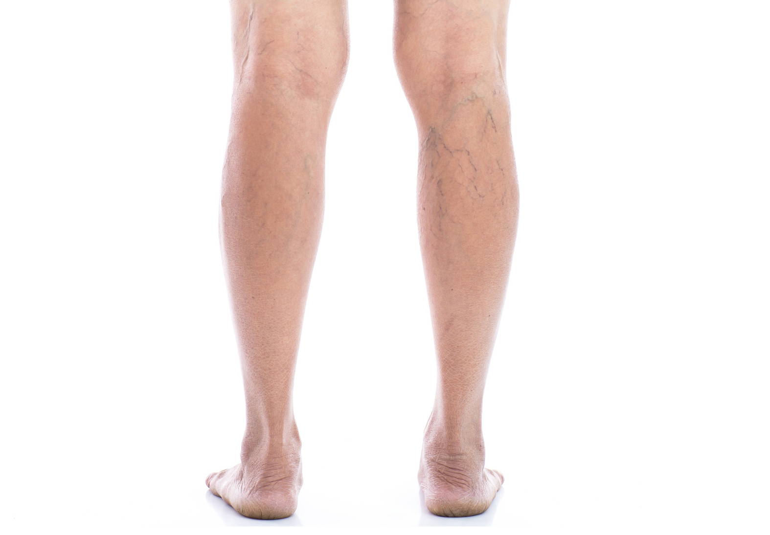 What Are Varicose Veins and how can they be treated? – Dr. Segal's - Canada