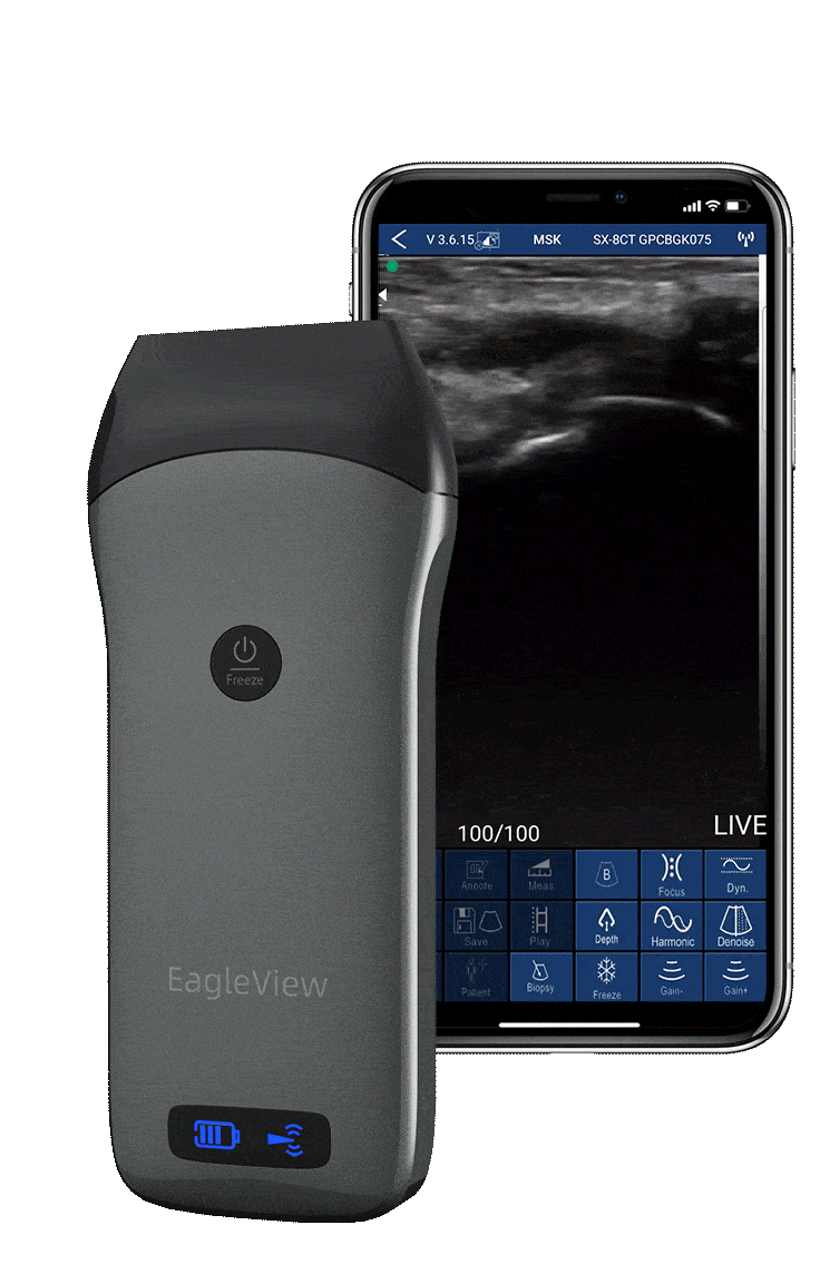 Wellue EagleView Linear Wireless Handheld Ultrasound mostra l'immagine vascolare sullo smartphone.