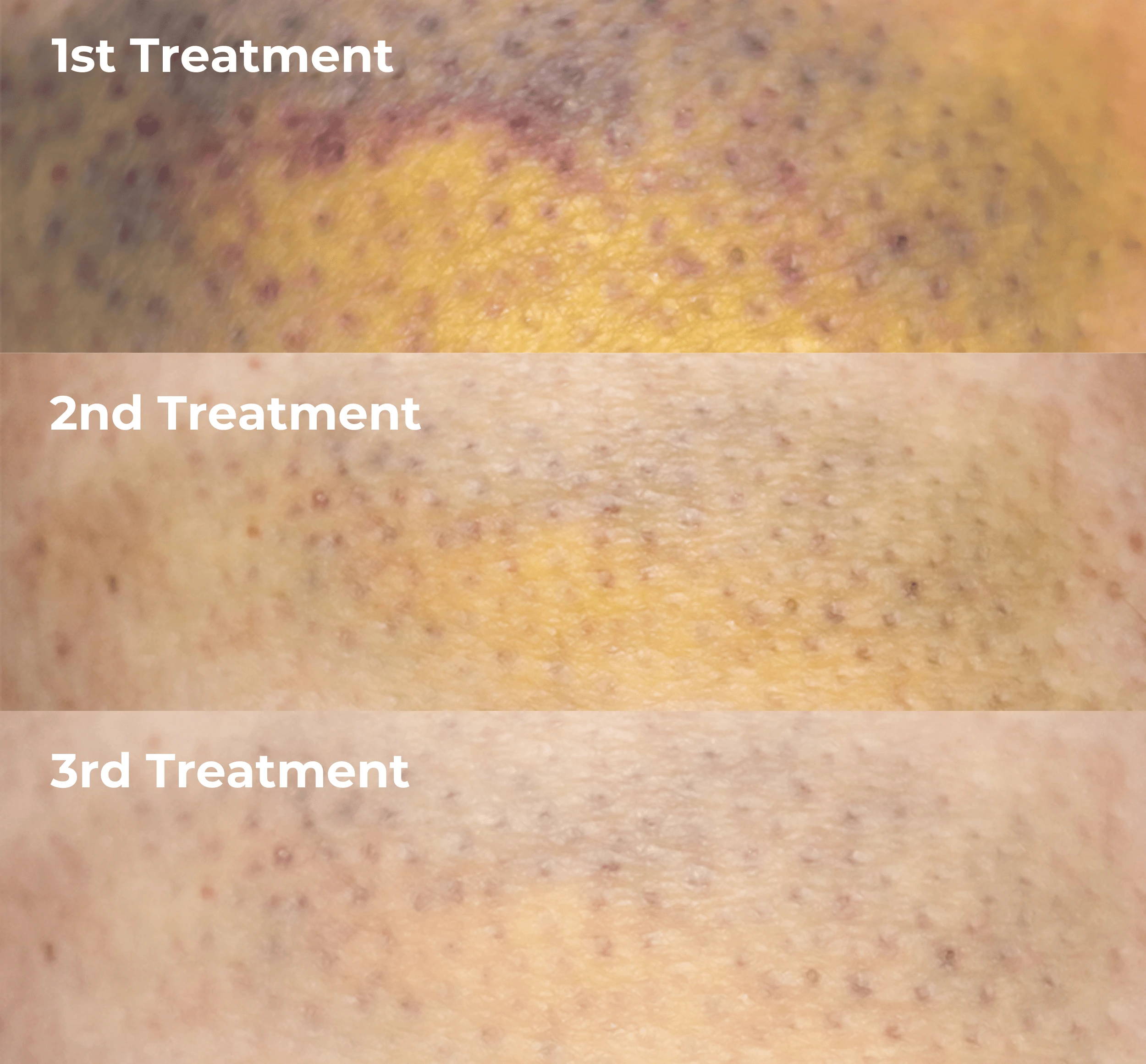 Your Laser therapy Journey