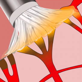 Illustration of metal dento-infusor tip in contact with mouth tissue