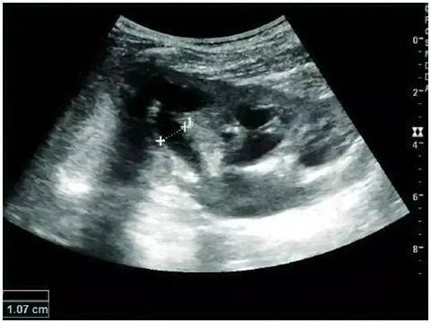 Renal pelvis, calyx dilation with cortical atrophy, scanned by EagleView portable ultrasound