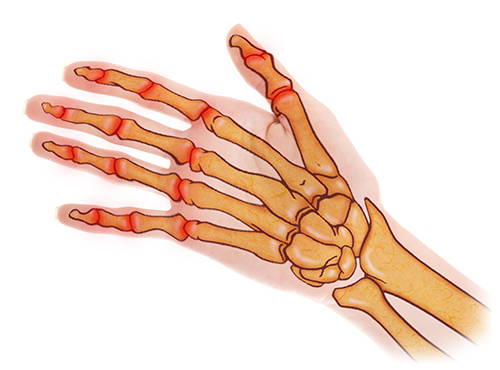 OSTEOARTHRITIS ILLUSTRATION