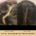 Hair Loss Treatment Dr Sknn Before & After Picture