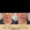 Anti-Wrinkle Injections Wilmslow Before & After Dr Sknn