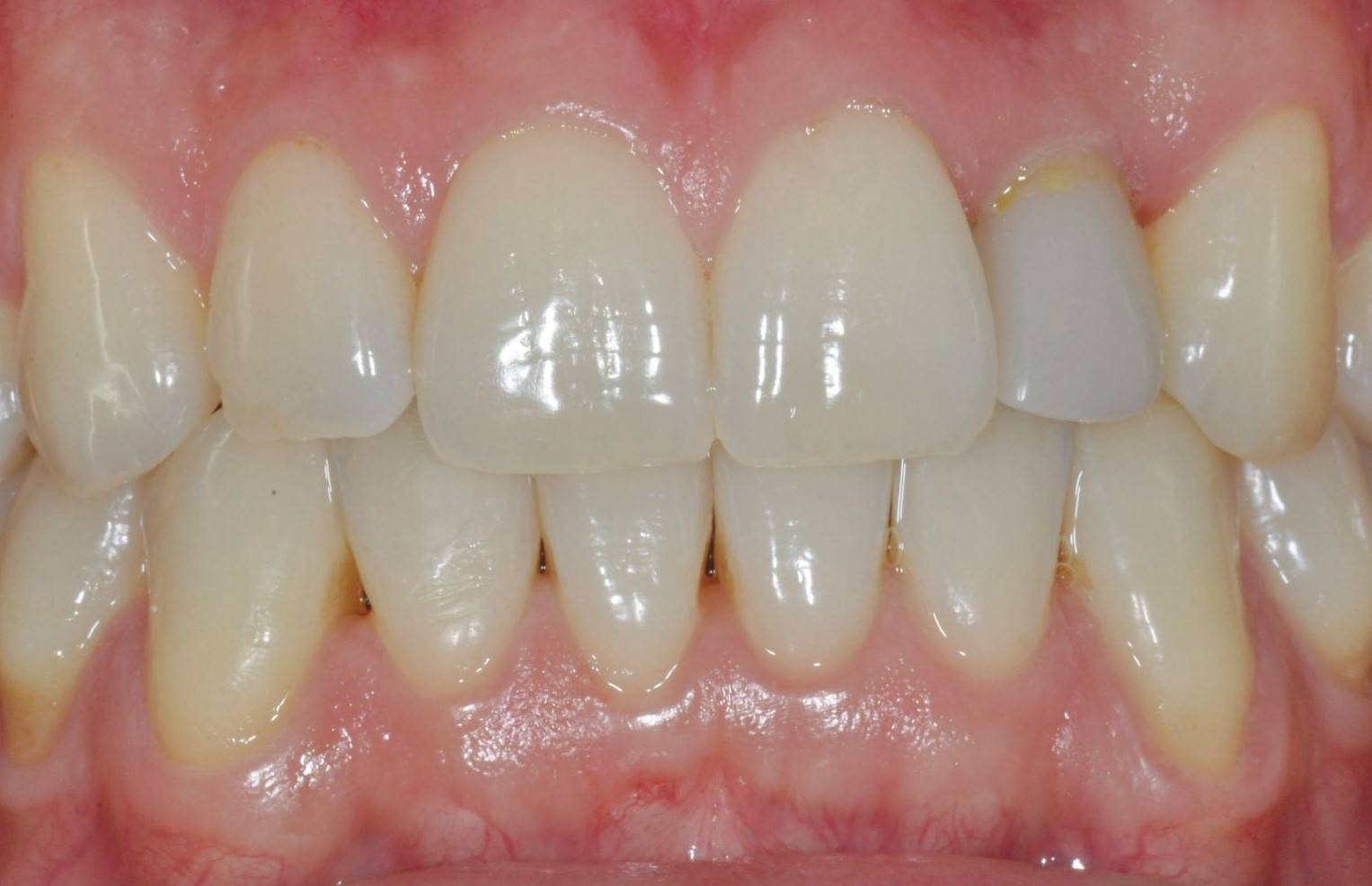 Closed mouth with focus on tissue shaping with implant