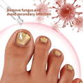 remove fungus and void secondary infection